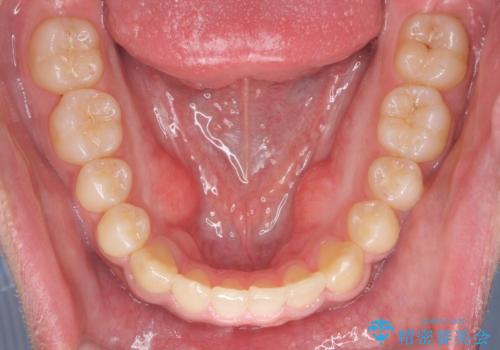 骨格性の受け口 非抜歯で下の歯を後ろに下げる インビザラインで インプラント矯正の治療後