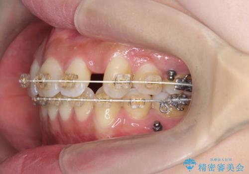 ガタつきと口元の改善　抜歯を伴うワイヤー矯正の治療中