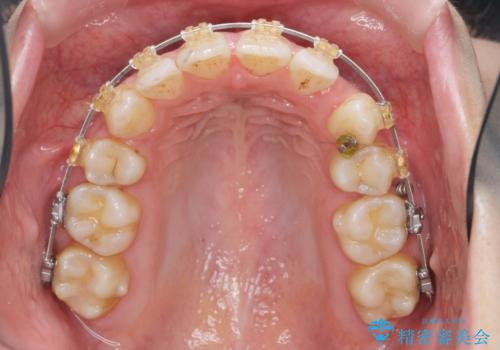 ガタつきと口元の改善　抜歯を伴うワイヤー矯正の治療中