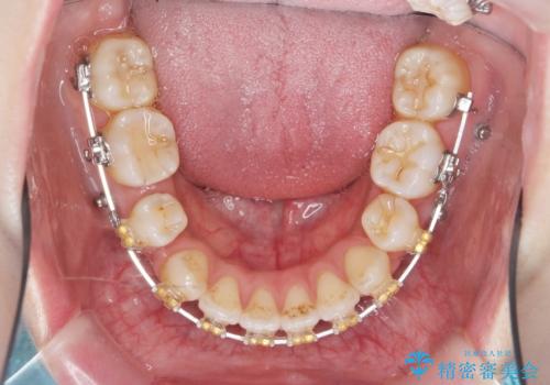 ガタつきと口元の改善 抜歯を伴うワイヤー矯正の治療中