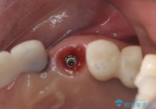 【抜歯即時埋入即時過重】1DAYインプラントの治療後