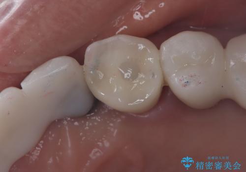 【抜歯即時埋入即時過重】1DAYインプラントの治療後