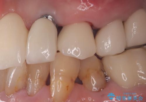 【抜歯即時埋入即時過重】1DAYインプラントの症例 治療後