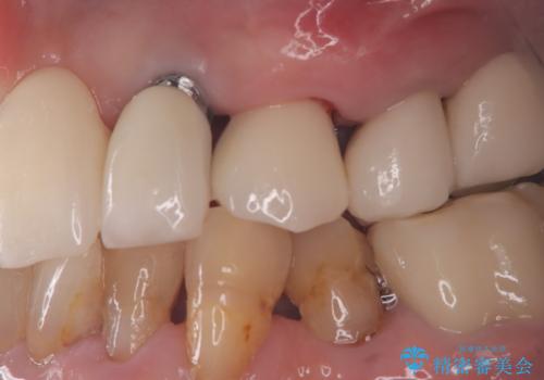 【抜歯即時埋入即時過重】1DAYインプラント