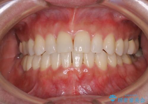 早い安いきれい!インビザラインライトで前歯のでこぼこ、反対咬合をなおすの治療中