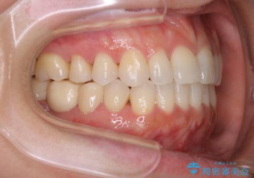 早い安いきれい!インビザラインライトで前歯のでこぼこ、反対咬合をなおすの治療中