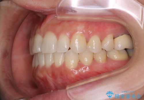 早い安いきれい!インビザラインライトで前歯のでこぼこ、反対咬合をなおすの治療中