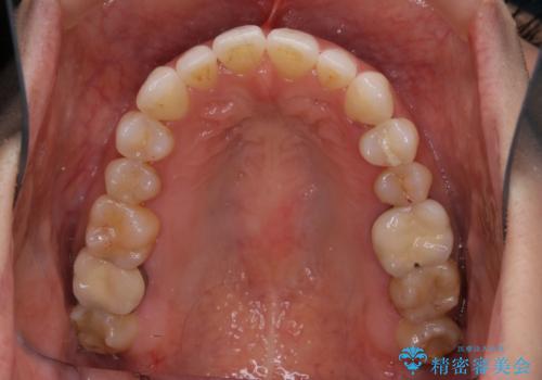 早い安いきれい!インビザラインライトで前歯のでこぼこ、反対咬合をなおすの治療中