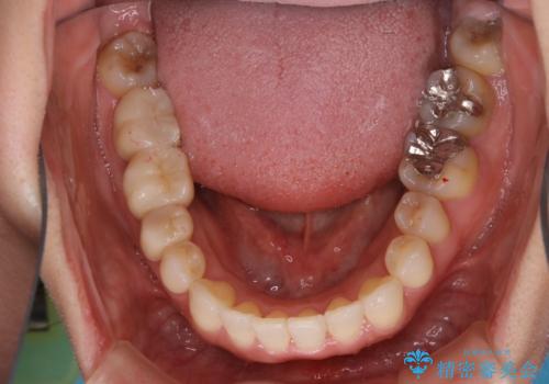 早い安いきれい!インビザラインライトで前歯のでこぼこ、反対咬合をなおすの治療中