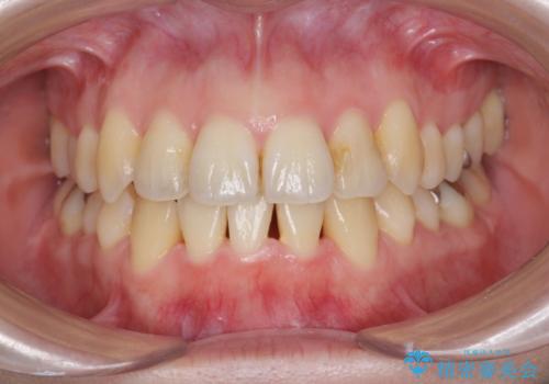 前歯のがたつき　すれ違い咬合のマウスピース矯正治療の症例 治療後