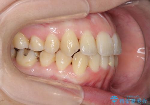 前歯のがたつき　すれ違い咬合のマウスピース矯正治療の治療後