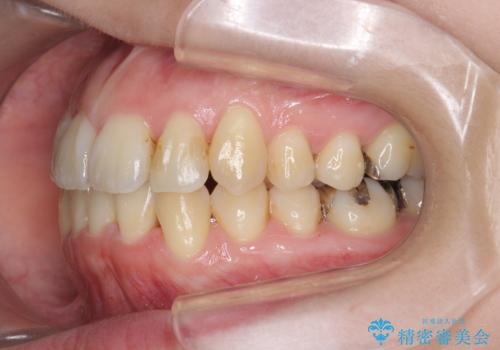 前歯のがたつき　すれ違い咬合のマウスピース矯正治療の治療後