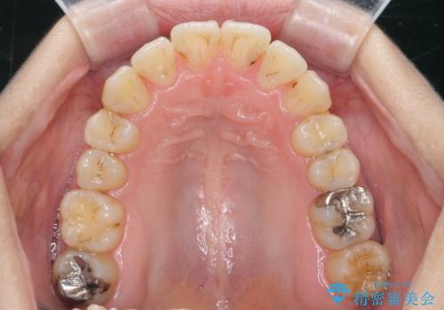 前歯のがたつき すれ違い咬合のマウスピース矯正治療の治療後