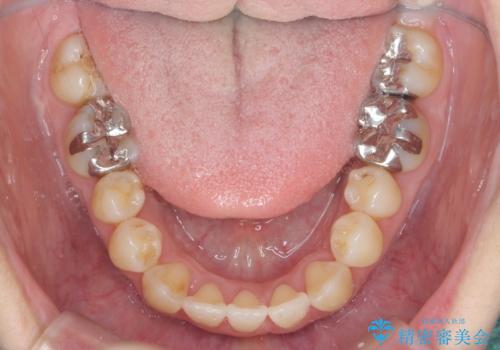 前歯のがたつき すれ違い咬合のマウスピース矯正治療の治療後
