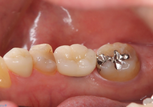 奥歯で食事をしたい インプラントとノンクラスプデンチャーによる治療の治療後