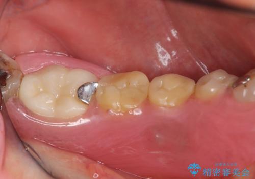 奥歯で食事をしたい インプラントとノンクラスプデンチャーによる治療の治療後