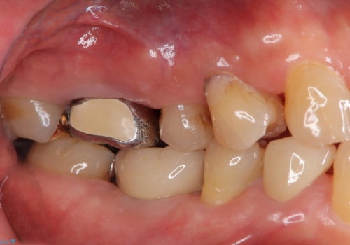 奥歯で食事をしたい　インプラントとノンクラスプデンチャーによる治療の治療後