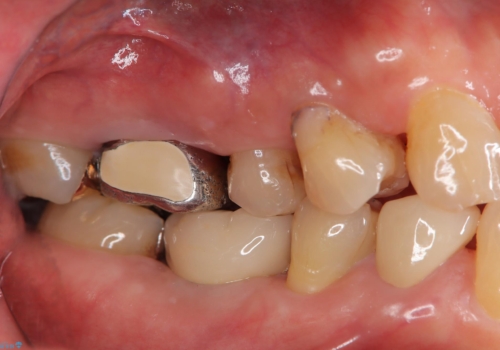 奥歯で食事をしたい インプラントとノンクラスプデンチャーによる治療の治療後
