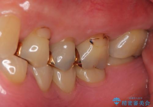 奥歯で食事をしたい インプラントとノンクラスプデンチャーによる治療の治療後