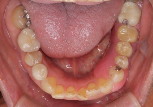 奥歯で食事をしたい　インプラントとノンクラスプデンチャーによる治療