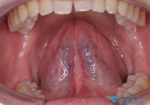 舌小帯の処置 滑舌が気になるの治療後