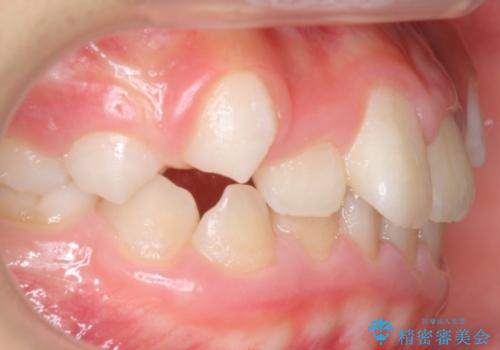 八重歯 歯を抜かずにインビザラインでの治療前