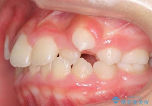八重歯 歯を抜かずにインビザラインでの治療前