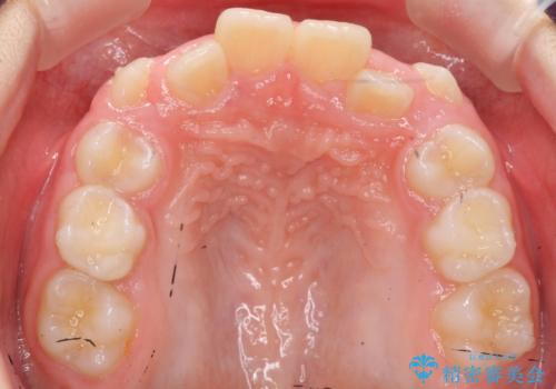 八重歯 歯を抜かずにインビザラインでの治療前