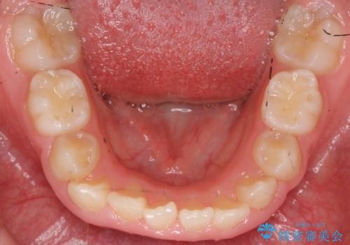 八重歯 歯を抜かずにインビザラインでの治療前