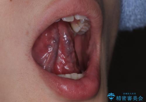 舌小帯の処置　滑舌が気になるの症例 治療後