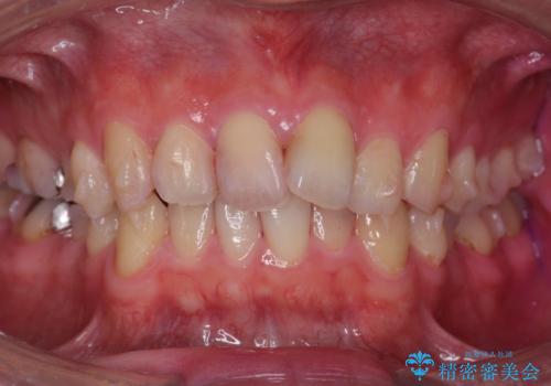 出っ歯と歯のねじれ 非抜歯で 30代男性の治療中