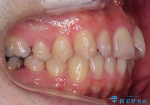 出っ歯と歯のねじれ　非抜歯で　30代男性の治療中