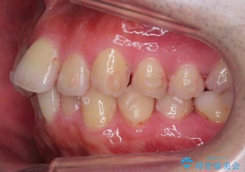 出っ歯と歯のねじれ 非抜歯で 30代男性の治療中