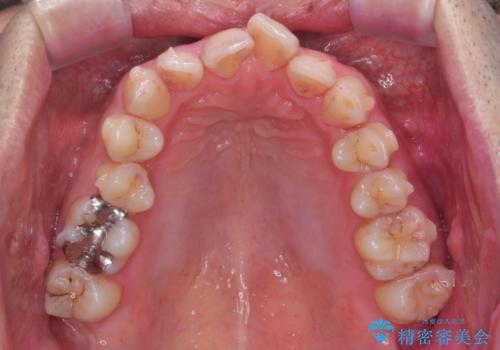 出っ歯と歯のねじれ　非抜歯で　30代男性の治療中