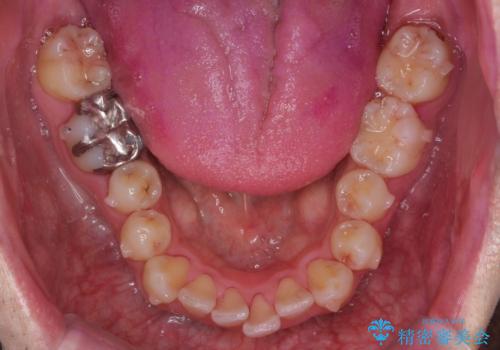 出っ歯と歯のねじれ 非抜歯で 30代男性の治療中