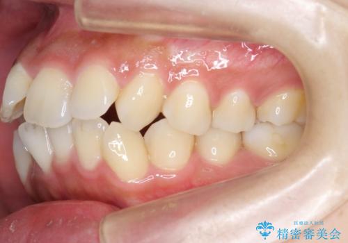 ガタつきと口元の改善 抜歯を伴うワイヤー矯正の治療前