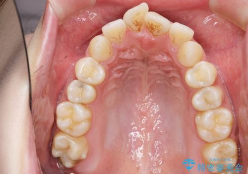 ガタつきと口元の改善 抜歯を伴うワイヤー矯正の治療前