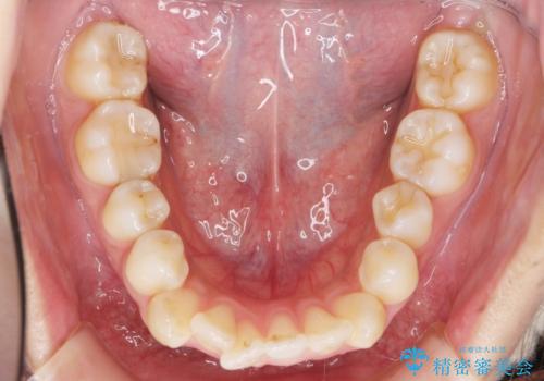 ガタつきと口元の改善 抜歯を伴うワイヤー矯正の治療前
