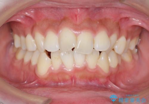 ガタつきと口元の改善　抜歯を伴うワイヤー矯正の症例 治療前
