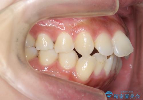 ガタつきと口元の改善 抜歯を伴うワイヤー矯正の治療前