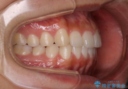 インビザライン矯正 過去に矯正治療したが、また前歯にがたつきがでてきて治したいの治療後