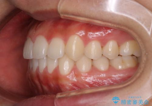 インビザライン矯正 過去に矯正治療したが、また前歯にがたつきがでてきて治したいの治療後