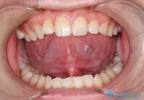 滑舌の向上を目指して! 舌小帯形成術の効果を実感しようの症例 治療後