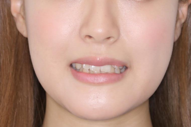 がたつきが強いガチャ歯。埋伏歯抜歯+矯正。すごいところに犬歯が埋まっていたのを抜いてワイヤー矯正治療の治療前(顔貌)