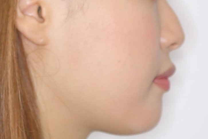 がたつきが強いガチャ歯。埋伏歯抜歯+矯正。すごいところに犬歯が埋まっていたのを抜いてワイヤー矯正治療の治療前(顔貌)