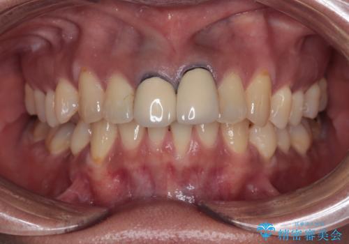 前歯の黒い縁が気になる　オールセラミッククラウンで自然な口元にの治療前