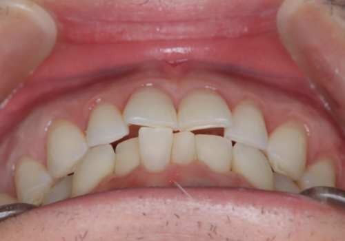 定期健診で歯並びを相談　セラミックブラケットでのワイヤー矯正例