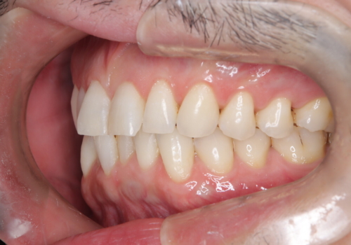 定期健診で歯並びを相談　セラミックブラケットでのワイヤー矯正例の治療前