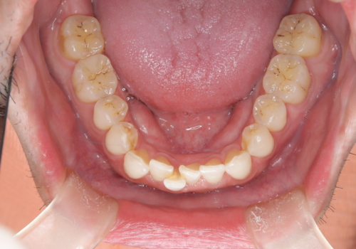 定期健診で歯並びを相談　セラミックブラケットでのワイヤー矯正例の治療前