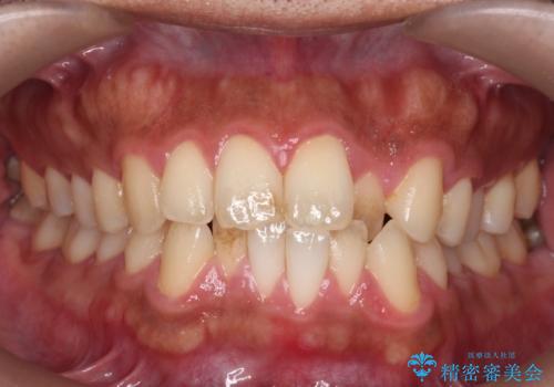 前歯が反対にかんでいる　部分ワイヤーとインビザラインの併用で短期治療の治療前